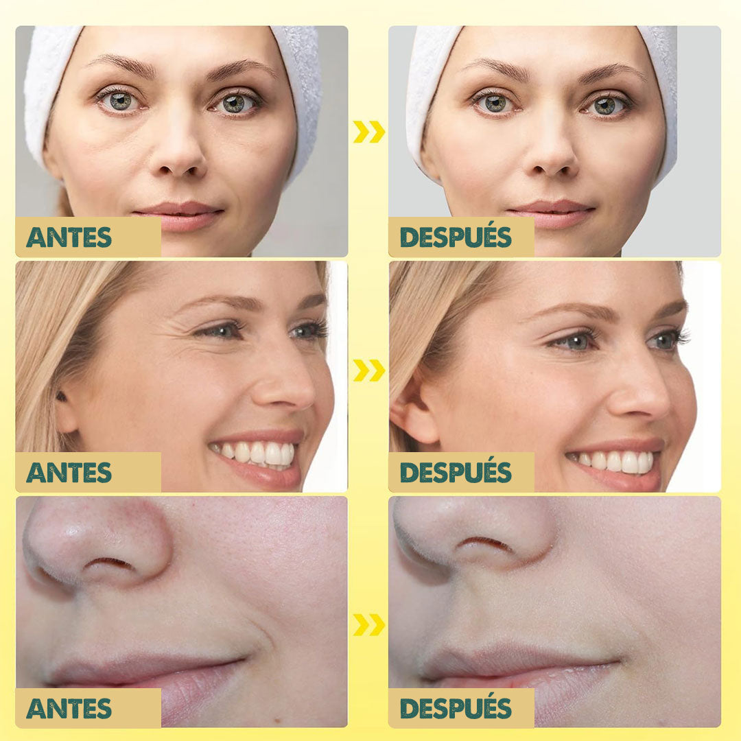 Botox Bee Venom - Reduce tus arrugas desde la primera aplicación