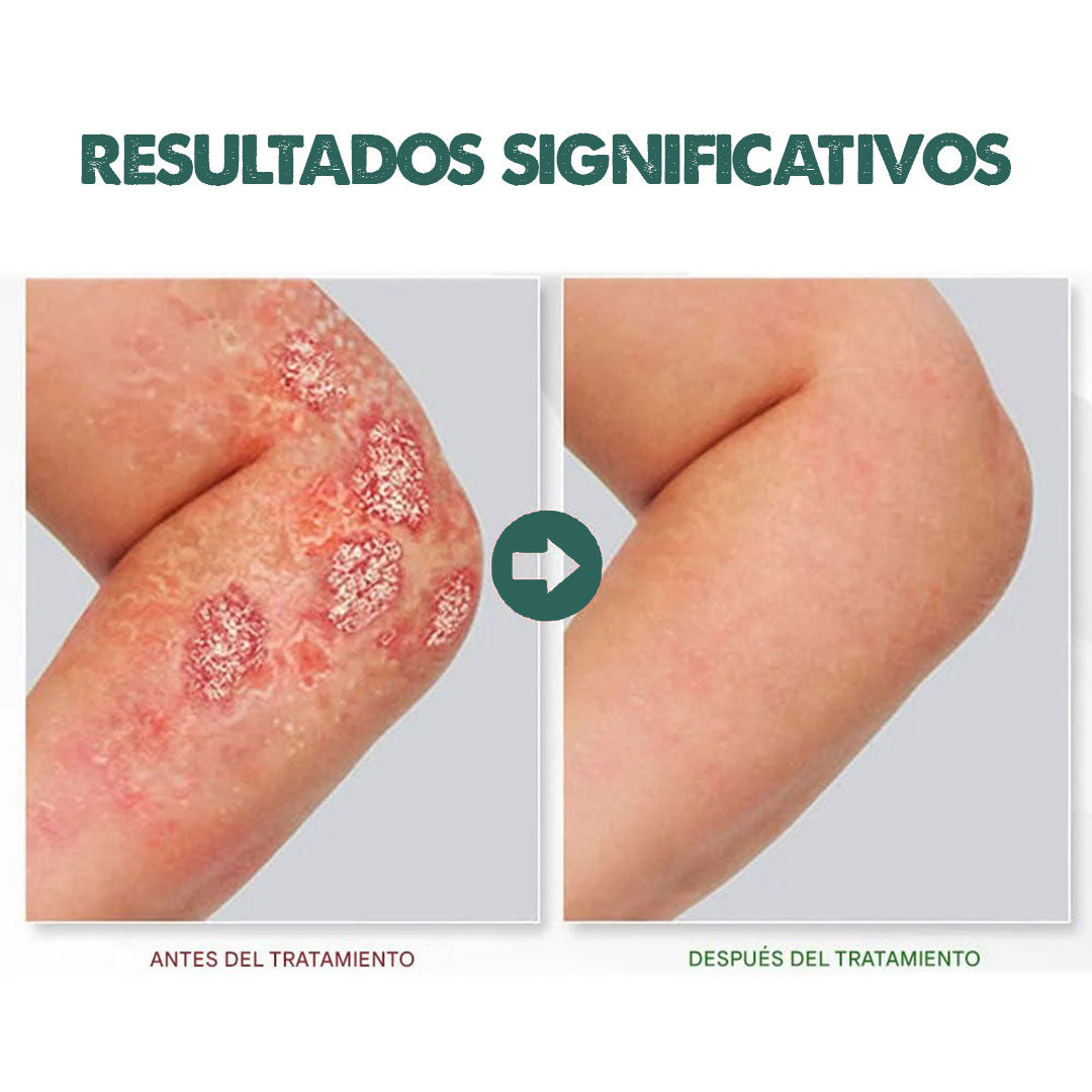 Eczema & Psoriasis Cream | Dile adiós a la irritación y molestias