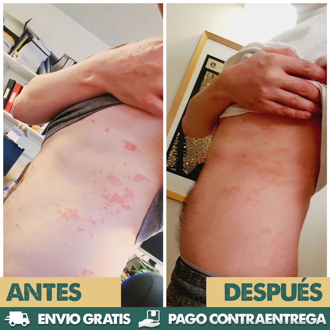 Eczema & Psoriasis Cream | Dile adiós a la irritación y molestias