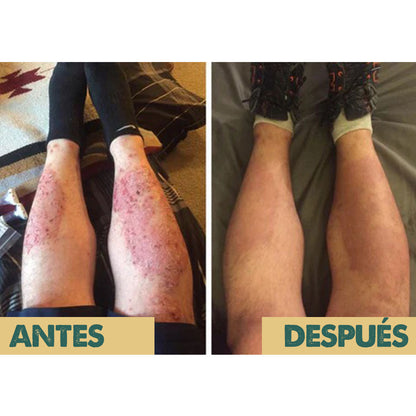 Eczema & Psoriasis Cream | Dile adiós a la irritación y molestias